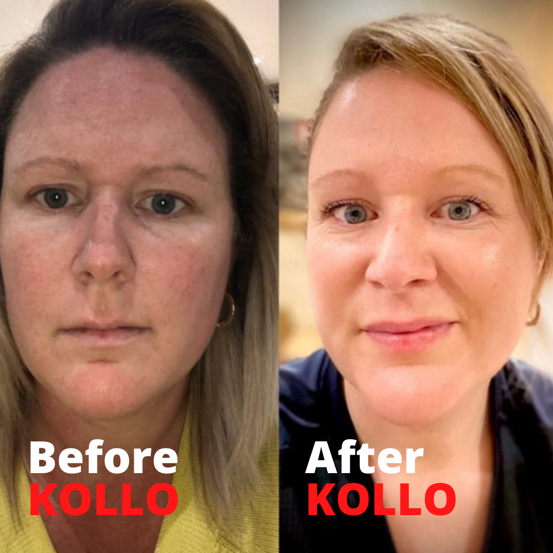 Where can I see collagen lift before and after pictures?