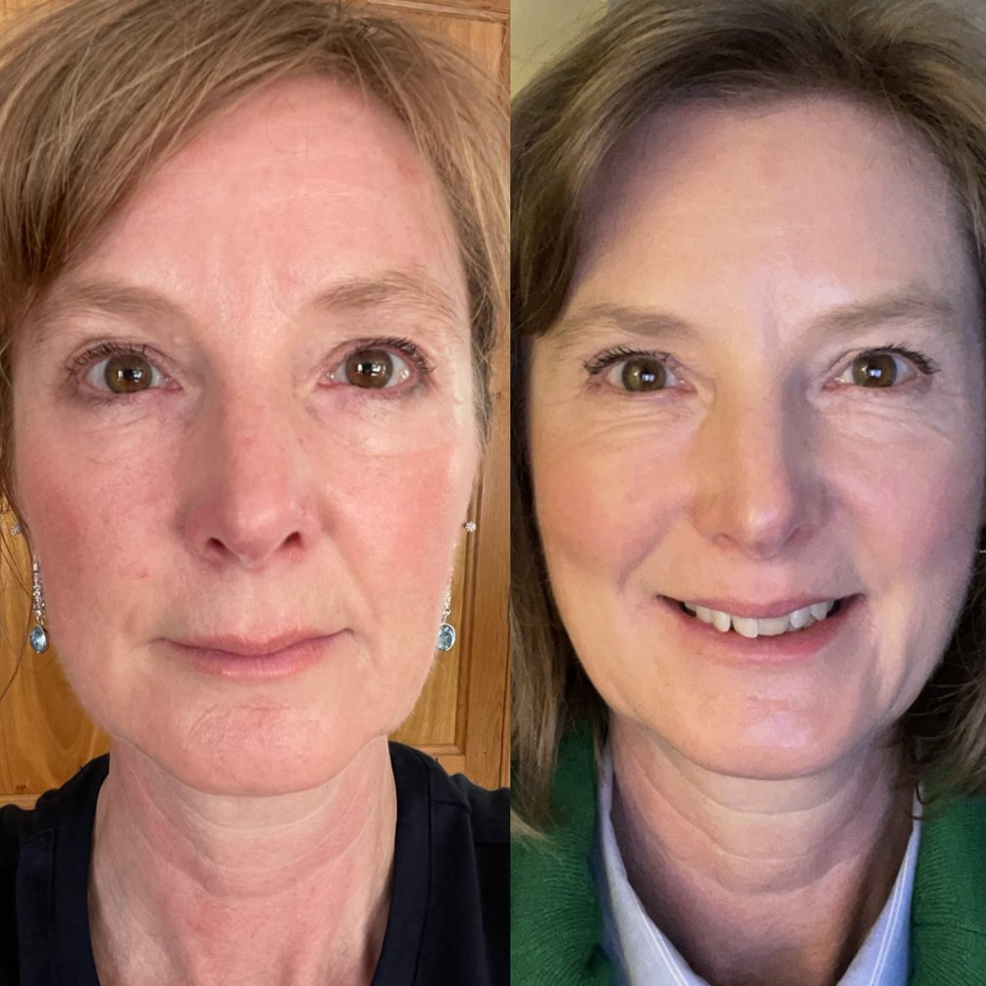 Kollo Customer Vanessa, Before and After Kollo