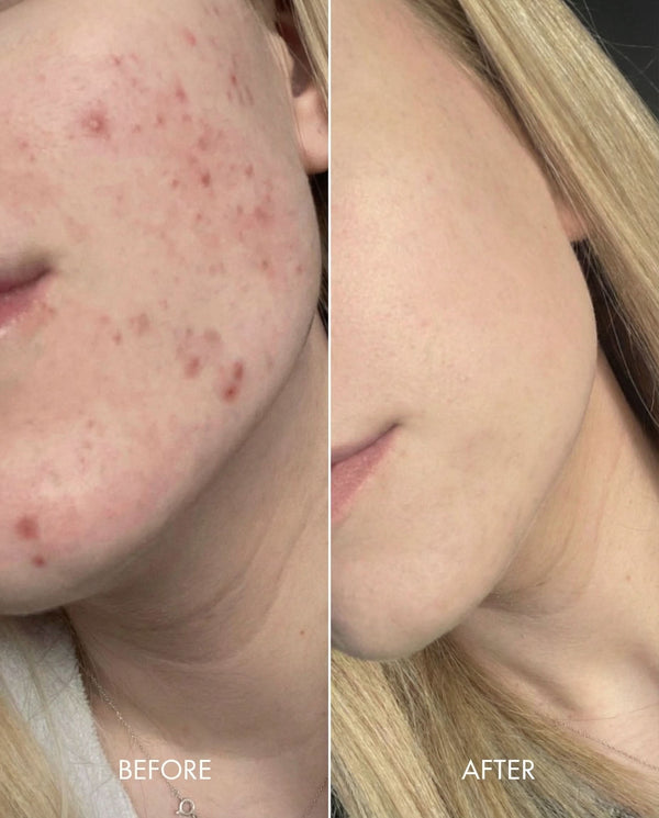 Kollo customer results